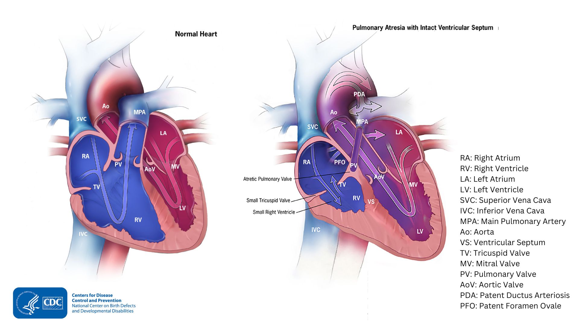 Normal heart illustration compared with pulmonary atresia with intact septum
