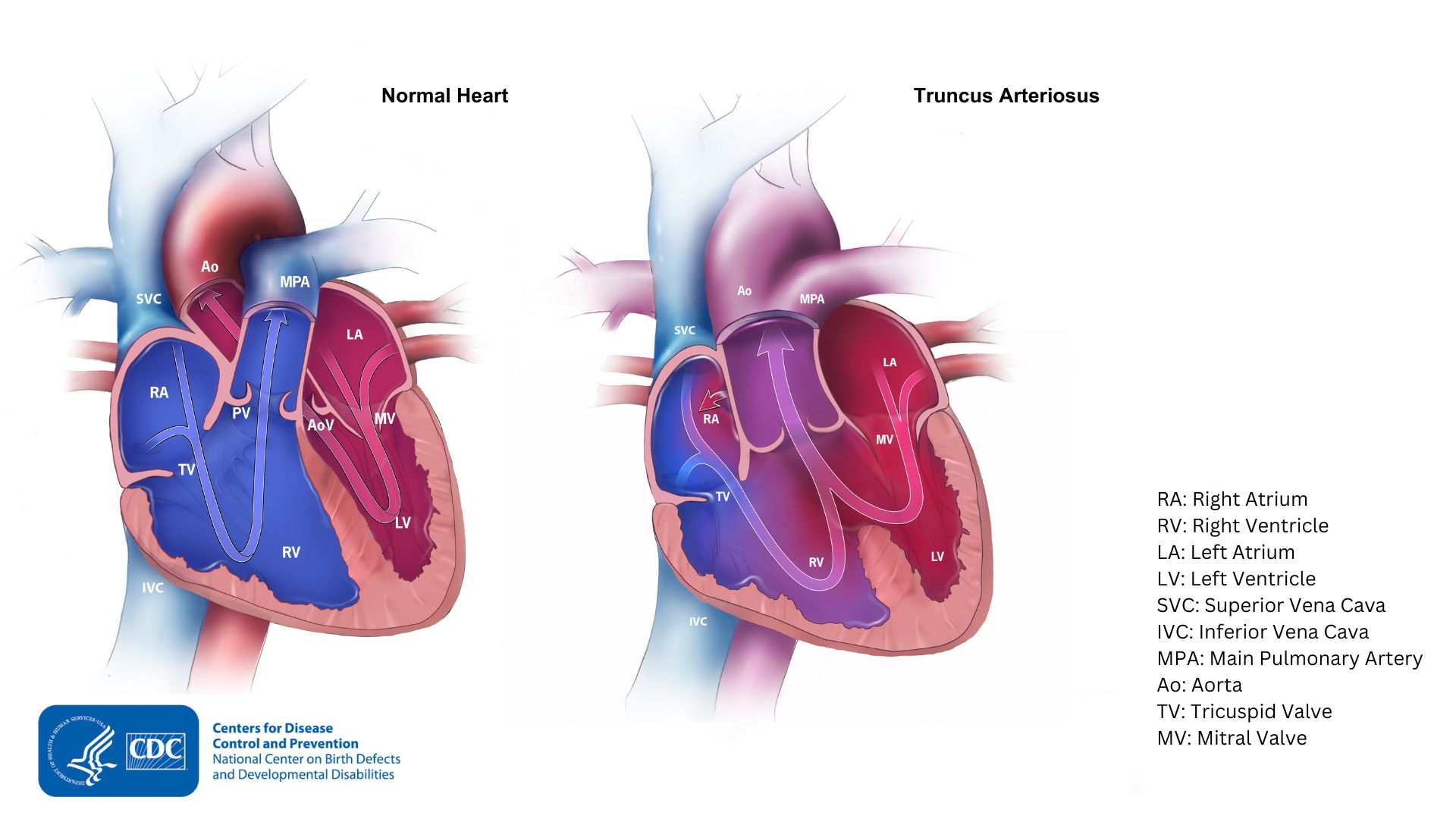 Normal heart compared to a heart with truncus arteriosus