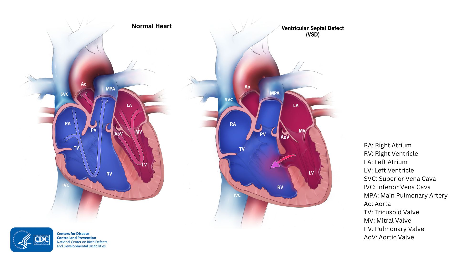 Normal heart compared with a heart with VSD