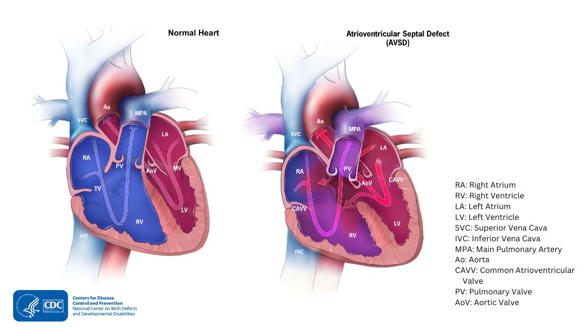 comparison of normal heart versus a heart with avsd