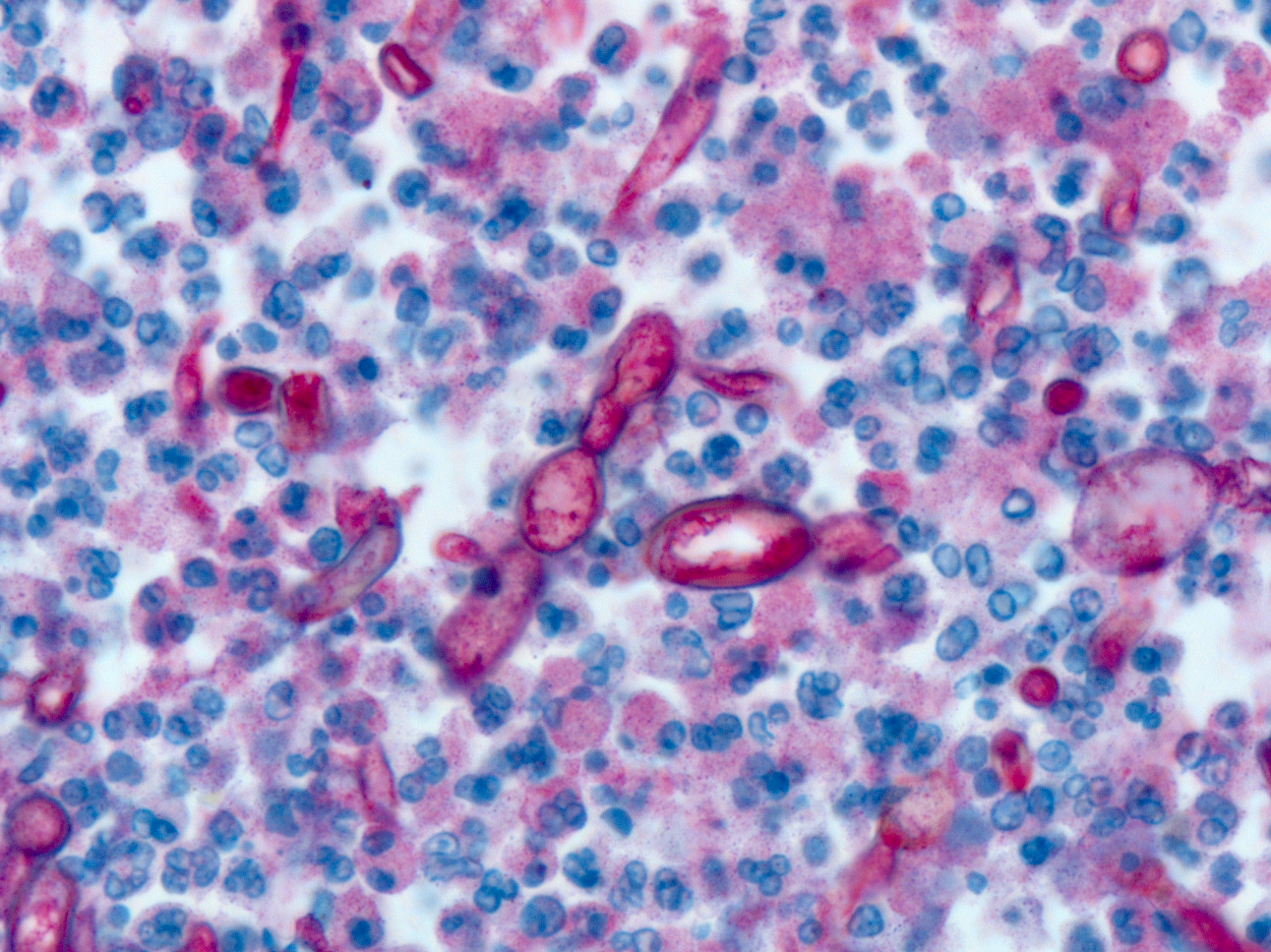 IHC showing Exserohilum fungus from 2012 fungal meningitis outbreak Immunohistochemistry (IHC) showing Exserohilum fungus in a case from the 2012 fungal meningitis outbreak