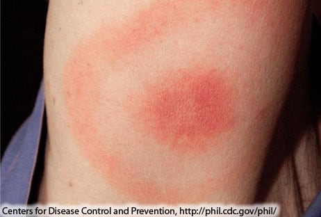 “Classic” Lyme disease rash Circular red rash with central clearing that slowly expands