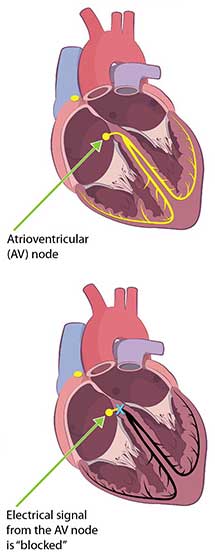 LymeCarditisThirdDegreeHeartBlock-stacked Cutout images of a heart showing third degree block