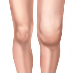 Rodilla inflamada