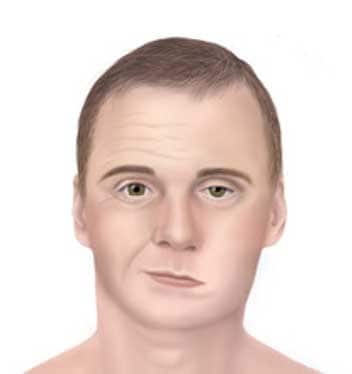 facial-palsy-nld Man displaying symptoms of facial palsy