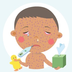 measles-child-image-250-250 Ilustración de un niño con sarampión