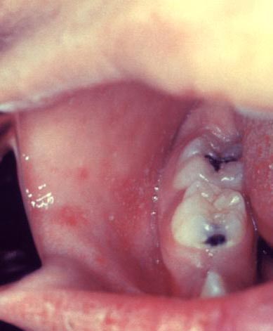 This patient presented on the third pre-eruptive day with %26ldquo;Koplik spots%26rdquo; indicative of the beginning onset of measles.