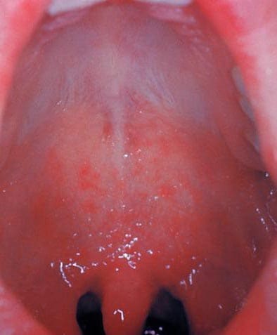 Mouth of a patient with Koplik spots, an early sign of measles infection.