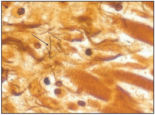 The figure above shows a Warthin-Starry stain of cardiac tissue demonstrating Borrelia burgdorferi spirochetes in one of three patients whose death was associated with Lyme carditis during November 12–July 2013.