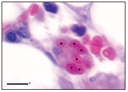 The figure shows stars indicating erythrocytes phagocytized by a macrophage in a hematoxylin and eosin-stained section of bone marrow biopsy from a patient with fatal dengue-associated hemophagocytic lymphohistiocytosis in 2012. The liver biopsy showed extensive liver damage, including marked steatosis and ballooning degeneration with neutro?philic and histiocytic aggregates and portal lymphocytic infiltrates. Macrophages with intracellular erythrocytes were noted in the bone marrow biopsy.