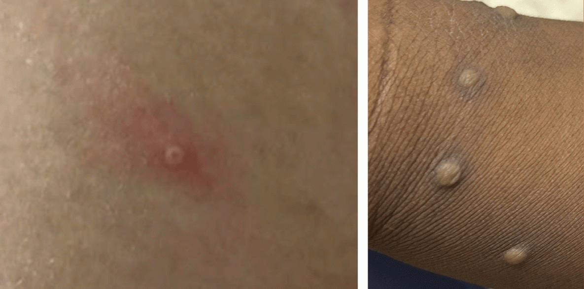 Monkeypox Outbreak — Nine States, May 2022 The figure is a set of two photographs illustrating characteristic monkeypox lesions from cases in the United States in 2022.