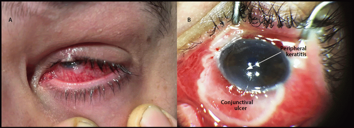 Ocular Monkeypox — United States, July–September 2022 The figure is a pair of images illustrating the left eye in a patient in the United States with HIV-associated immunocompromise and ocular monkeypox, with conjunctivitis and conjunctival lesion earlier in the course of monkeypox illness, and with conjunctival ulcer and peripheral keratitis later in the course of monkeypox illness during August–September 2022.