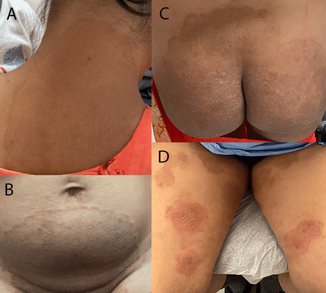 Notes from the Field: First Reported U.S. Cases of Tinea Caused by Trichophyton indotineae — New York City, December 2021–March 2023 The figure includes four photographs of lesions occurring on the neck, abdomen, and thigh areas of two patients in New York City, caused by the first reported U.S. cases of tinea due to Trichophyton indotineae infection during December 2021–March 2023.