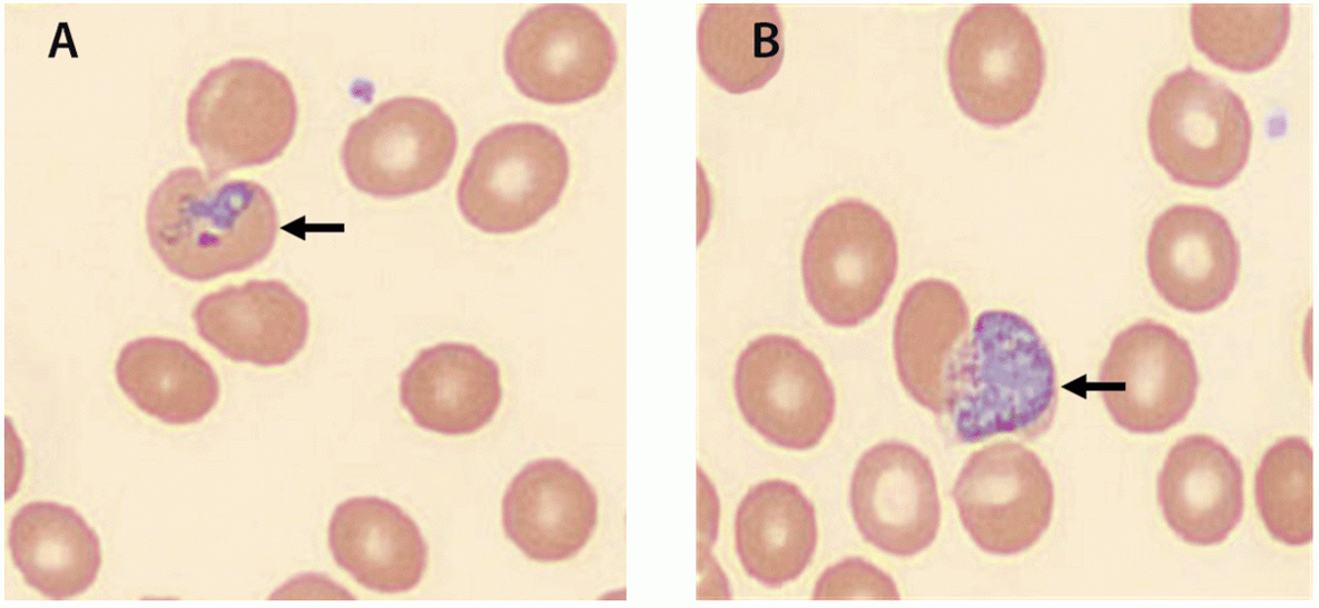 Outbreak of Locally Acquired Mosquito-Transmitted (Autochthonous) Malaria — Florida and Texas, May–July 2023 The figure is an image of a thin blood smear illustrating Plasmodium vivax ring-form trophozoite and gametocyte in Florida and Texas during May 2023.