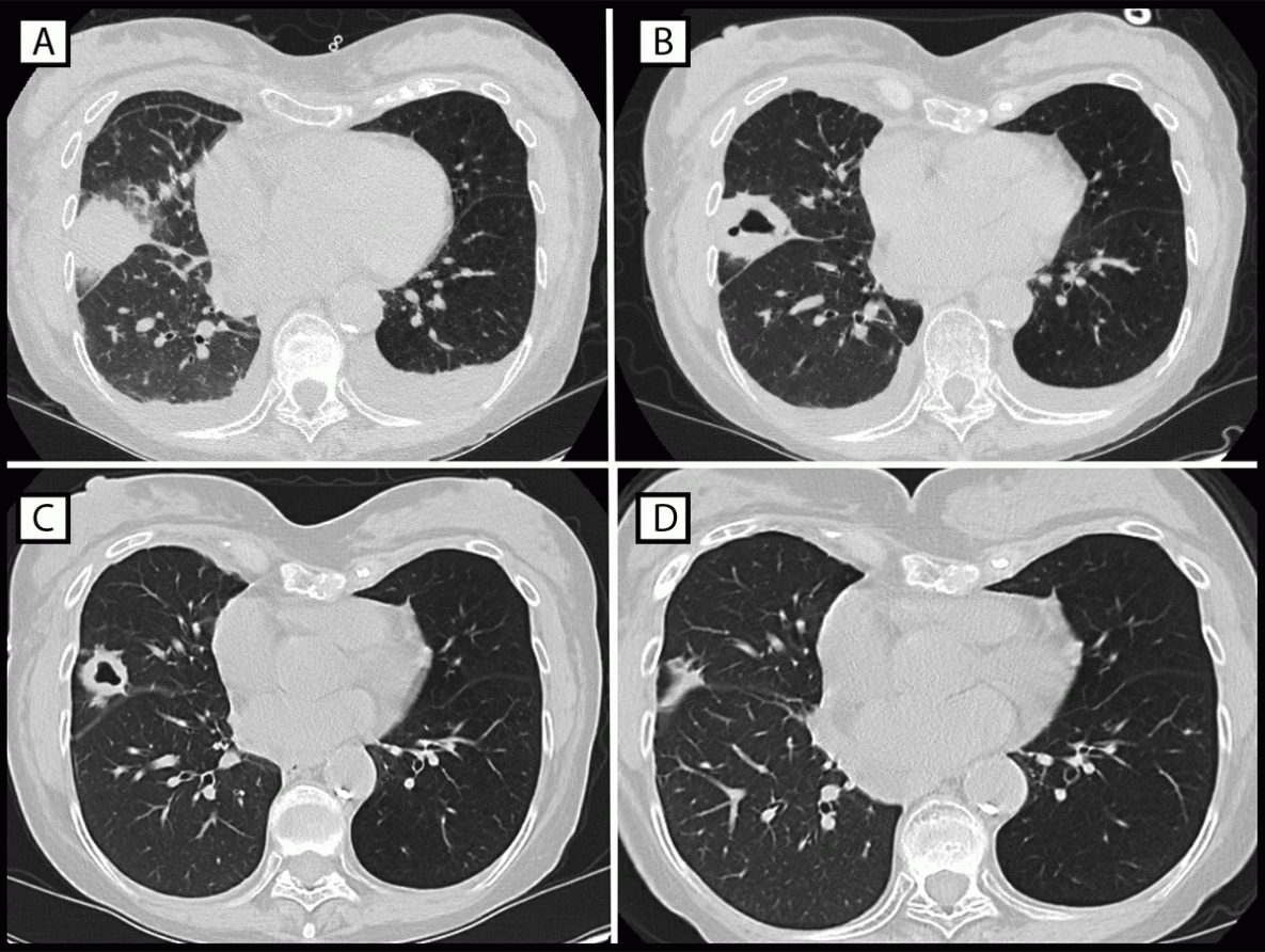 Suspected Legionella Transmission from a Single Donor to Two Lung Transplant Recipients — Pennsylvania, May 2022 The figure consists of computed tomography images of the chest of patient A, who experienced infection with Legionella species (other than Legionella pneumophila) after receipt of a transplanted right lung from a donor who had drowned in fresh water. Features of the images include dense consolidative opacity with surrounding ground glass opacification on postoperative day 9, thick-walled cavitation on postoperative day 16, resolving lesion with thinning of cavity walls on postoperative day 29, and continuing improvement on postoperative day 119.