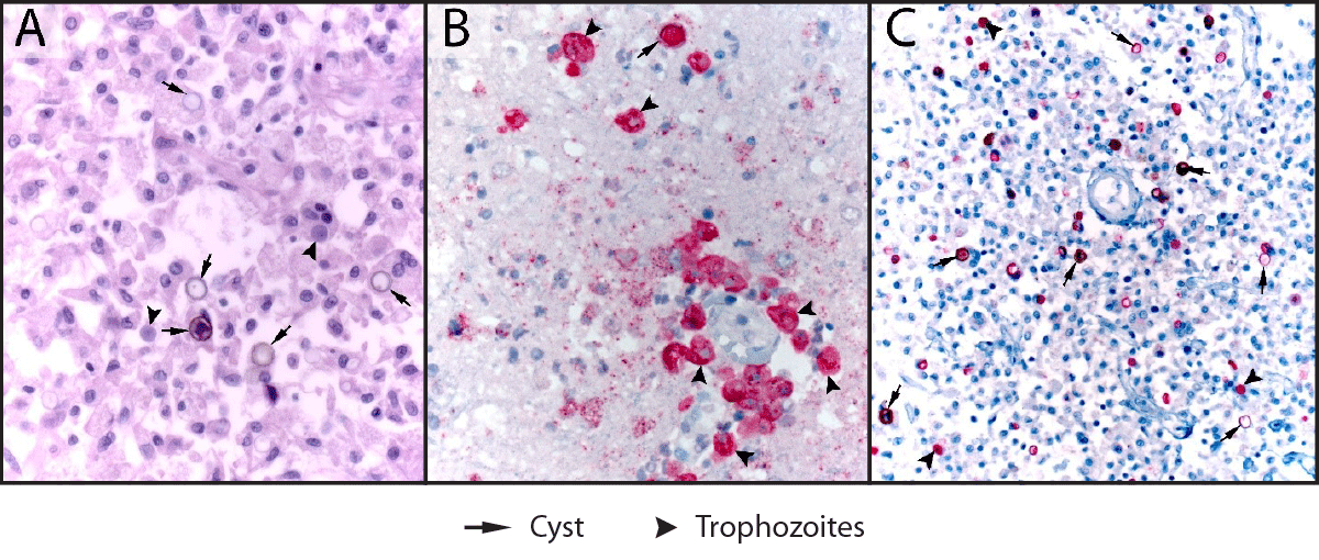 Notes from the Field: Fatal Acanthamoeba Encephalitis in a Patient Who Regularly Used Tap Water in an Electronic Nasal Irrigation Device and a Continuous Positive Airway Pressure Machine at Home — New Mexico, 2023 The figure is a series of 3 photos depicting the histopathologic findings in a fatal case of granulomatous amebic encephalitis caused by Acanthamoeba T4 genotype.