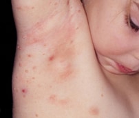 A child looks at molluscum bumps on their arm and arm pit. Image: Scott Norton MD, MPH, Dept. of Dermatology, WRAMC