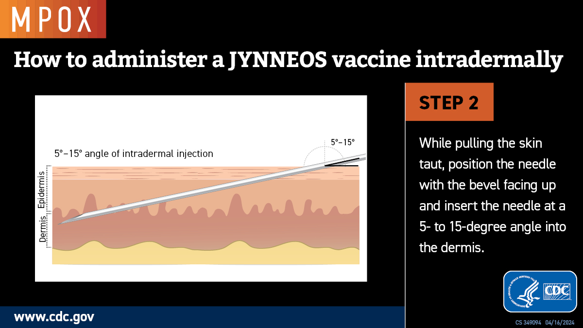 Graphic showing the correct angle to insert a needle for monkeypox intradermal vaccination.