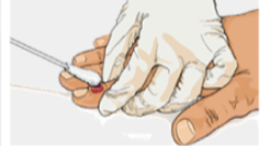 an illustration of a healthcare worker collecting an mpox specimen from a patient's finger