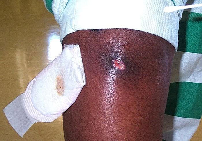 Photograph depicted a cutaneous abscess, caused by MRSA