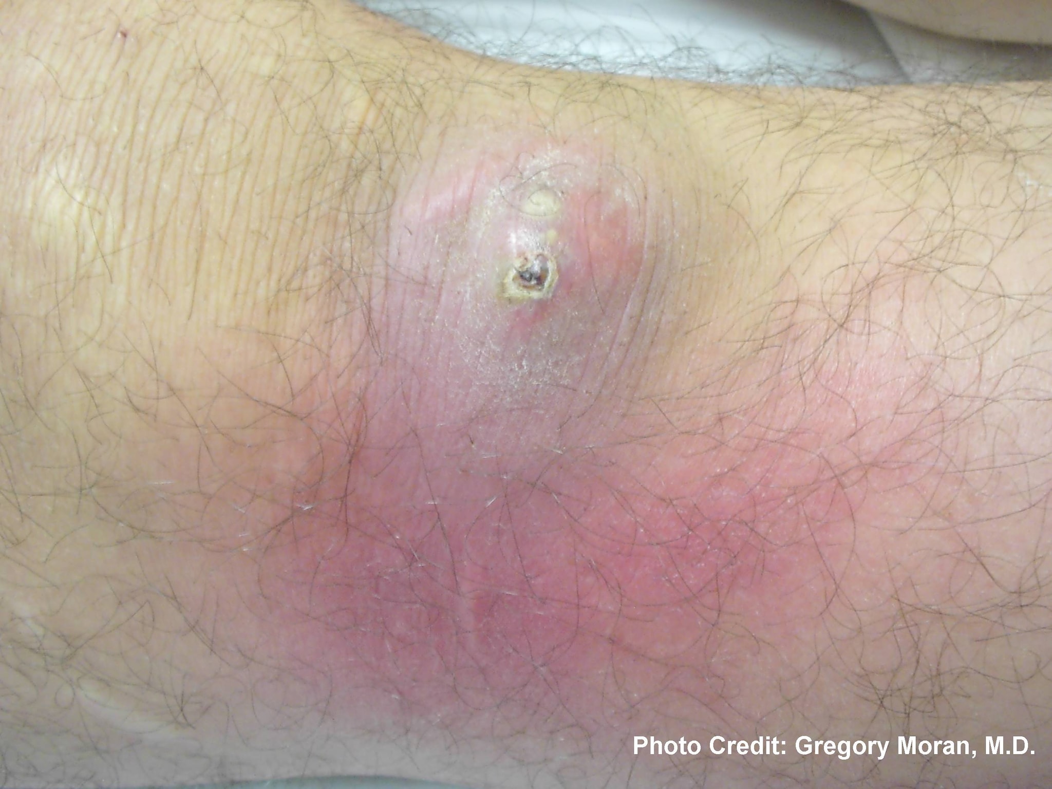 Photograph depicted a cutaneous abscess, caused by MRSA