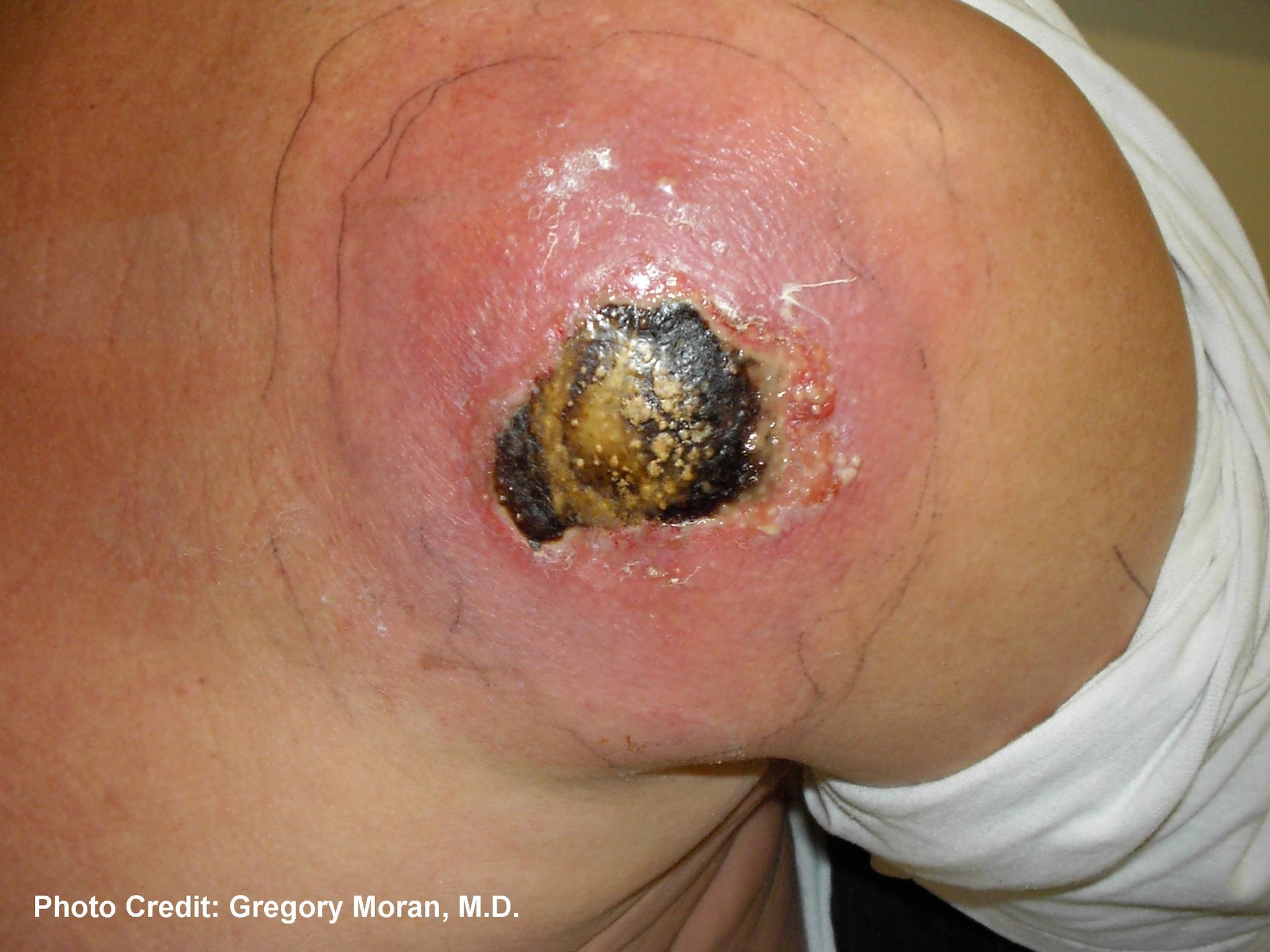 Photograph depicted a cutaneous abscess on the foot post packing (side view)