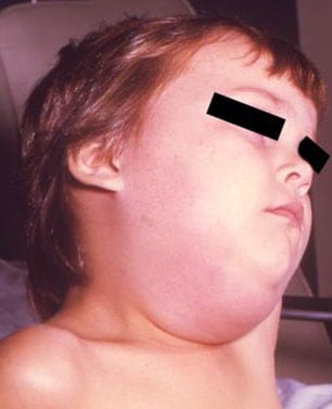 people_mumps.jpg Child with mumps
