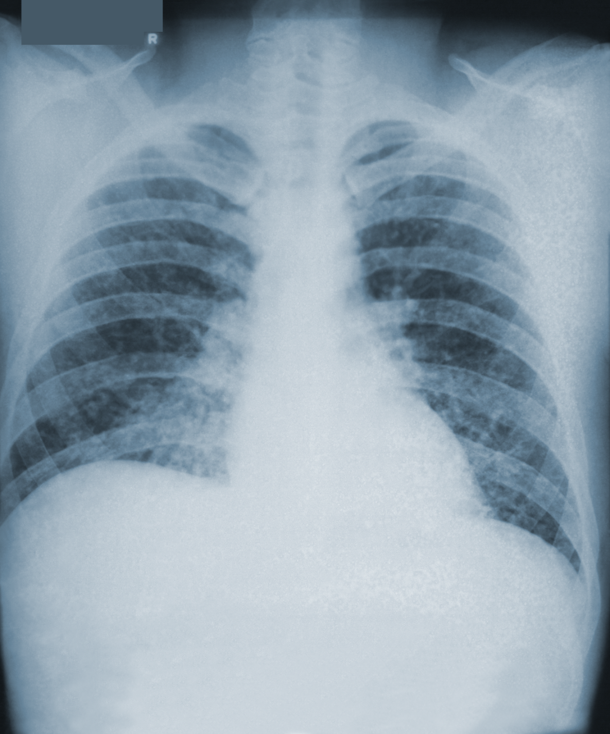intro02 A chest x-ray of a patient with histoplasmosis shows thin thready areas in the lungs