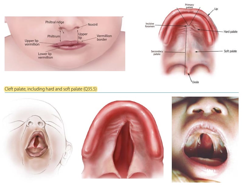 Fig. 4.22. Cleft palate, including hard and soft palate Fig. 4.22. Cleft palate, including hard and soft palate