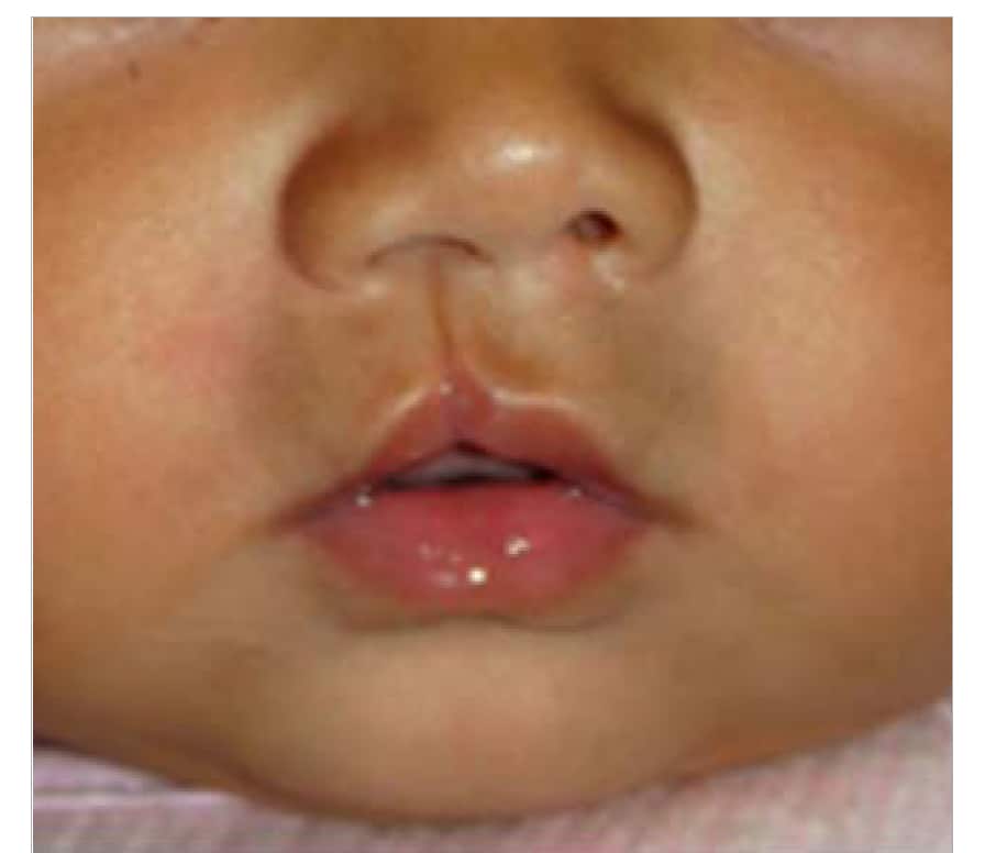 Fig. 4.25. Microform (“healed” cleft lip) Fig. 4.25. Microform (“healed” cleft lip)