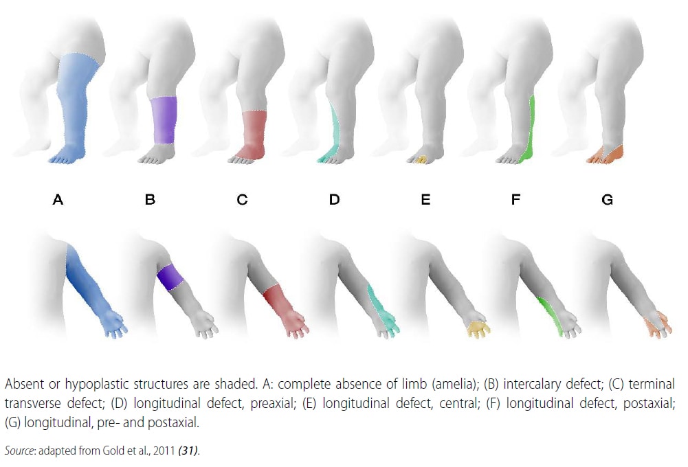 Fig. 4.35. Types of limb deficiencies by axis and segment involved Fig. 4.35. Types of limb deficiencies by axis and segment involved