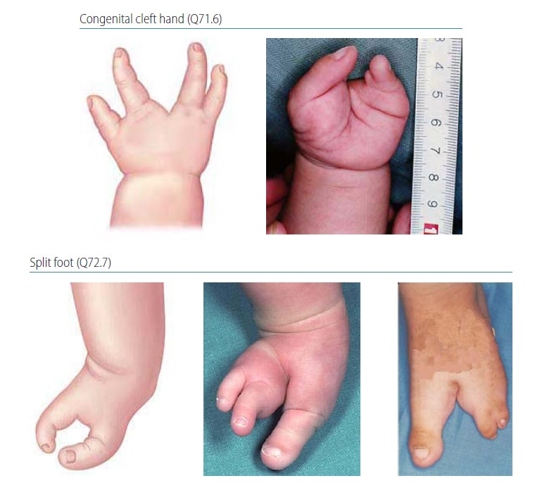 Fig. 4.41. Split hand and foot Fig. 4.41. Split hand and foot