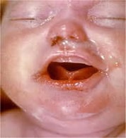 fig5.3.2 Typical desquamating and maculopapular skin lesions