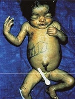 fig5.3.3 Hepatosplenomegaly and jaundice in an infant with congenital syphilis. Black markings on infant indicate liver margins.
Photograph source: Dr Ronald Ballard.