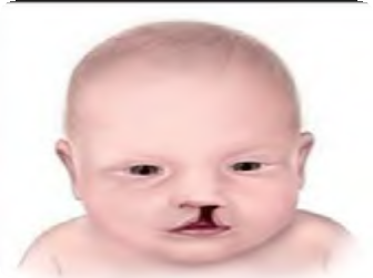Illustration of a Unilateral cleft lip