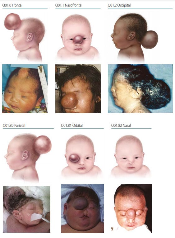Fig. 5. Encephalocele Fig. 5. Encephalocele