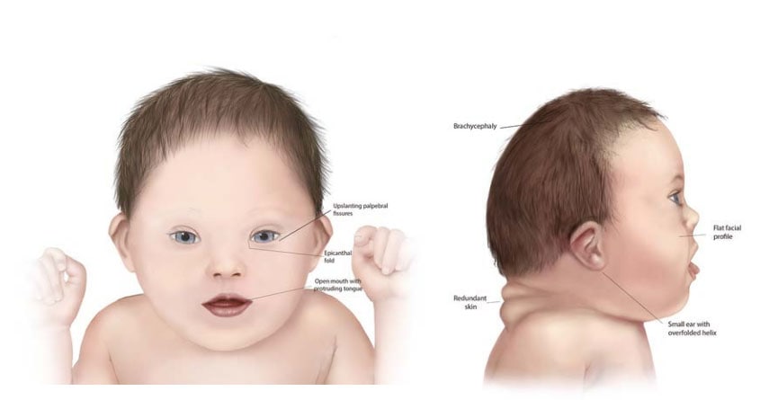 Fig. 52. Common traits in trisomy 21 (Down syndrome) Fig. 52. Common traits in trisomy 21 (Down syndrome)