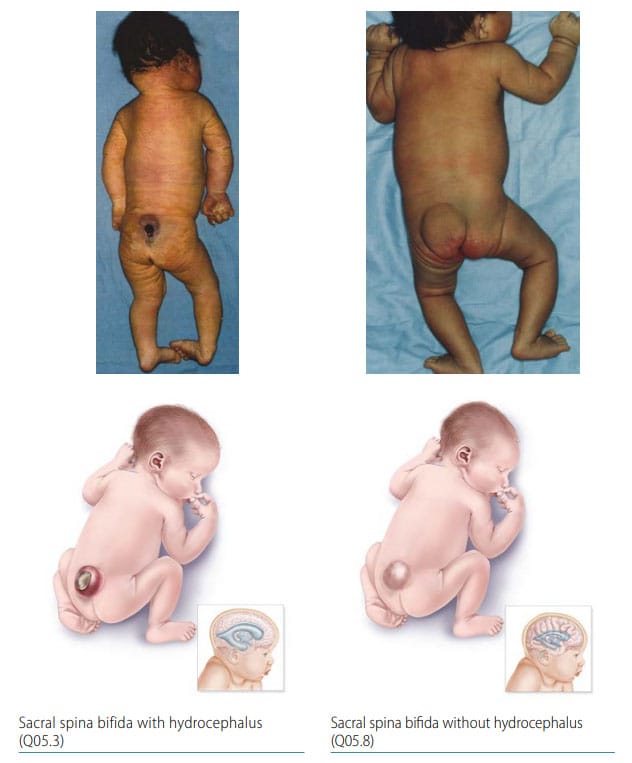 Fig. 10. Sacral spina bifida Fig. 10. Sacral spina bifida