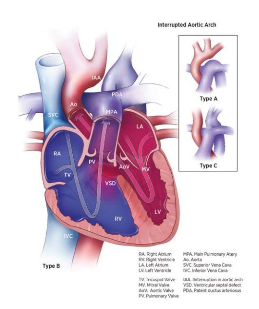 Fig. 20. Interrupted aortic arch Fig. 20. Interrupted aortic arch
