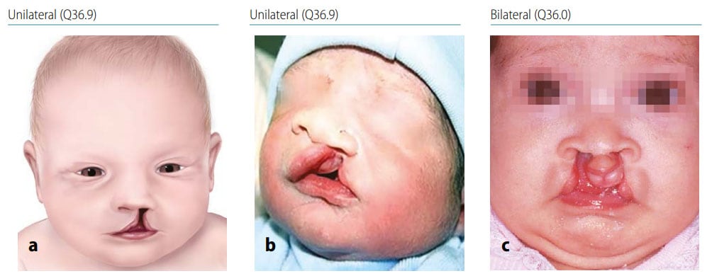 Fig. 24. Cleft lip Fig. 24. Cleft lip