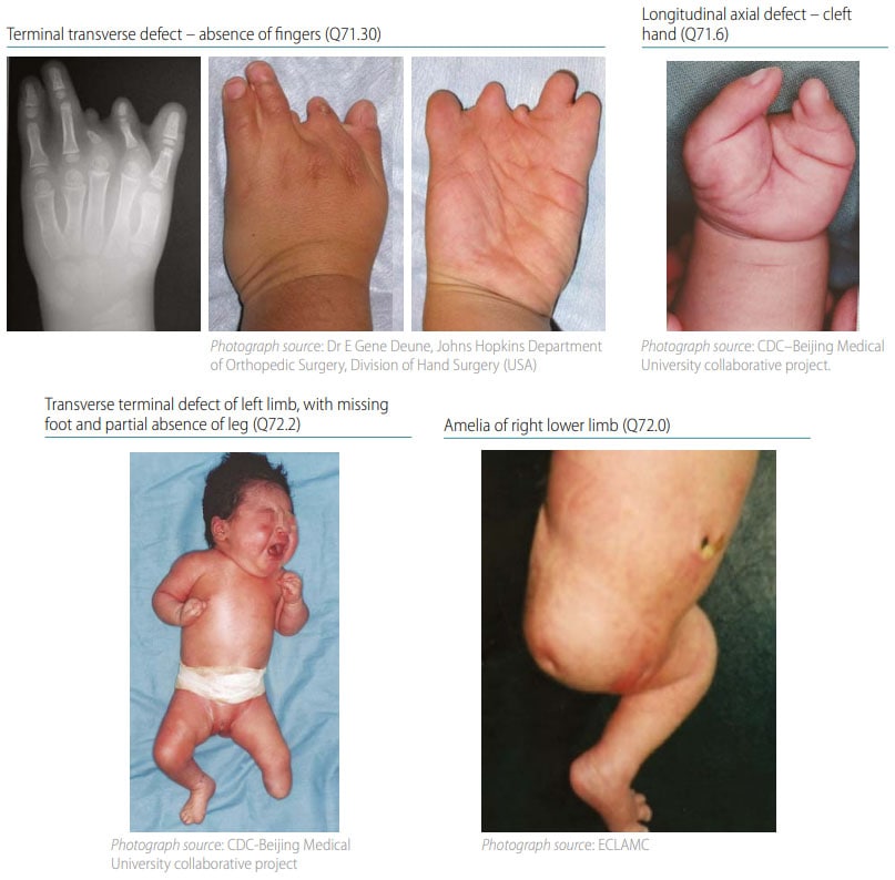 Fig. 39. Distinguishing transverse terminal defects from longitudinal axial defects and amelia Fig. 39. Distinguishing transverse terminal defects from longitudinal axial defects and amelia (side-by-side comparison)