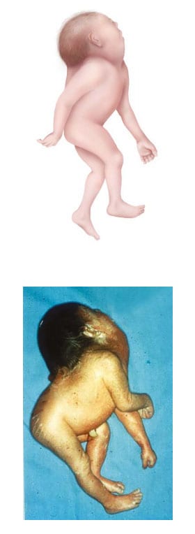 Fig. 4. Iniencephaly Fig. 4. Iniencephaly