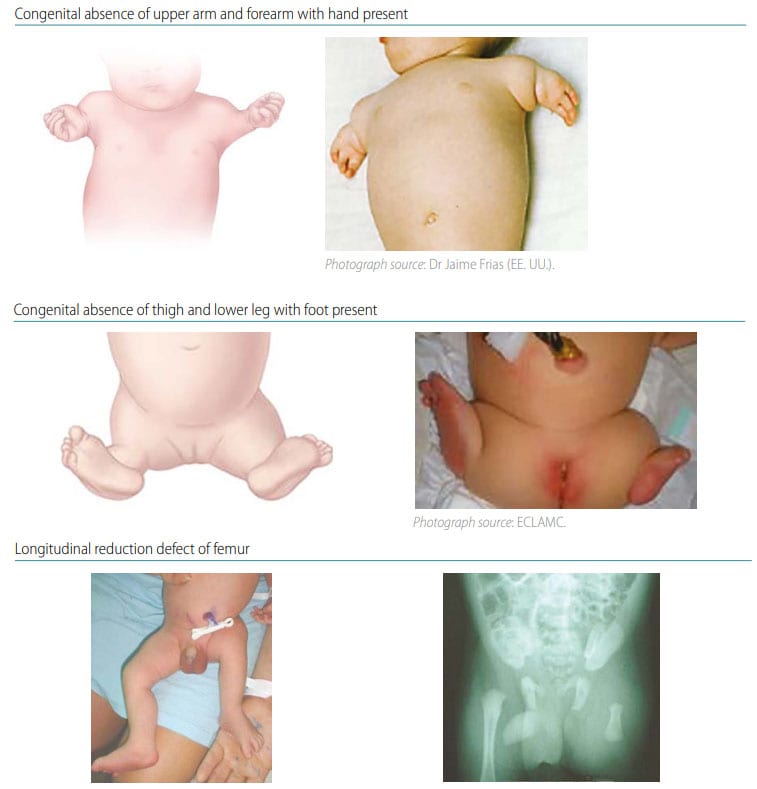 Fig. 40. Transverse intercalary Fig. 40. Transverse intercalary