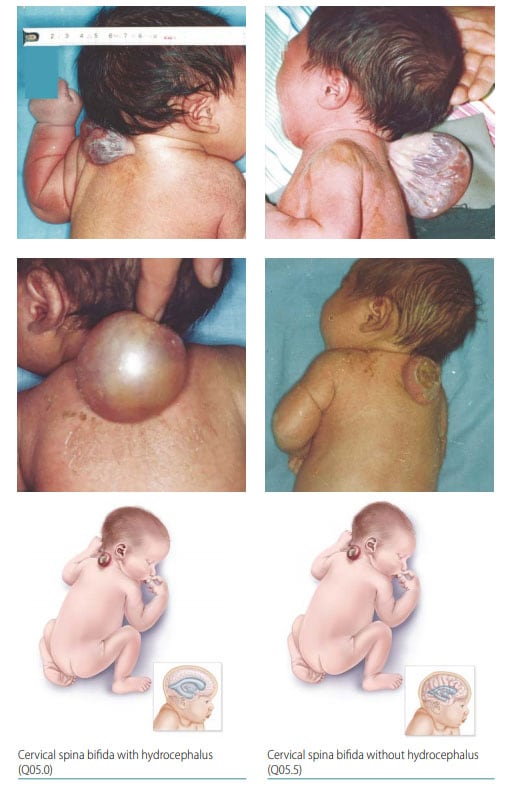 Fig. 7. Cervical spina bifida Fig. 7. Cervical spina bifida