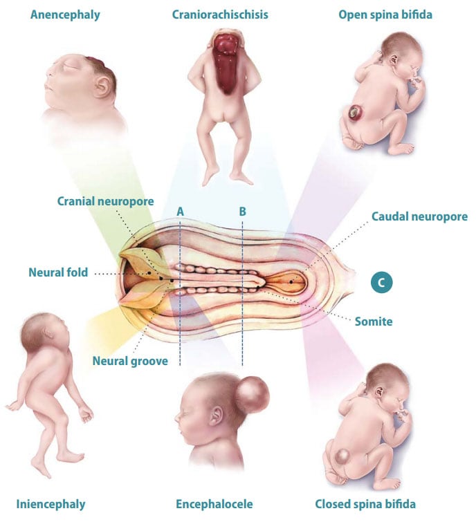 fig1-pt2 Neural tube defects