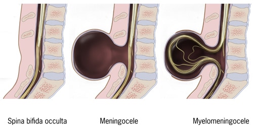 typesofSpinabifida.jpg_38c04 Types of spina bifida: Spina bifida occulta, meningocele, myelomeningocele