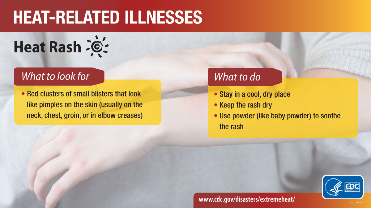 Heat-Related IIlnesses: Heat Rash Heat-related illnesses social media graphic for heat rash. More info at www.cy118119.com/disasters/extremeheat/