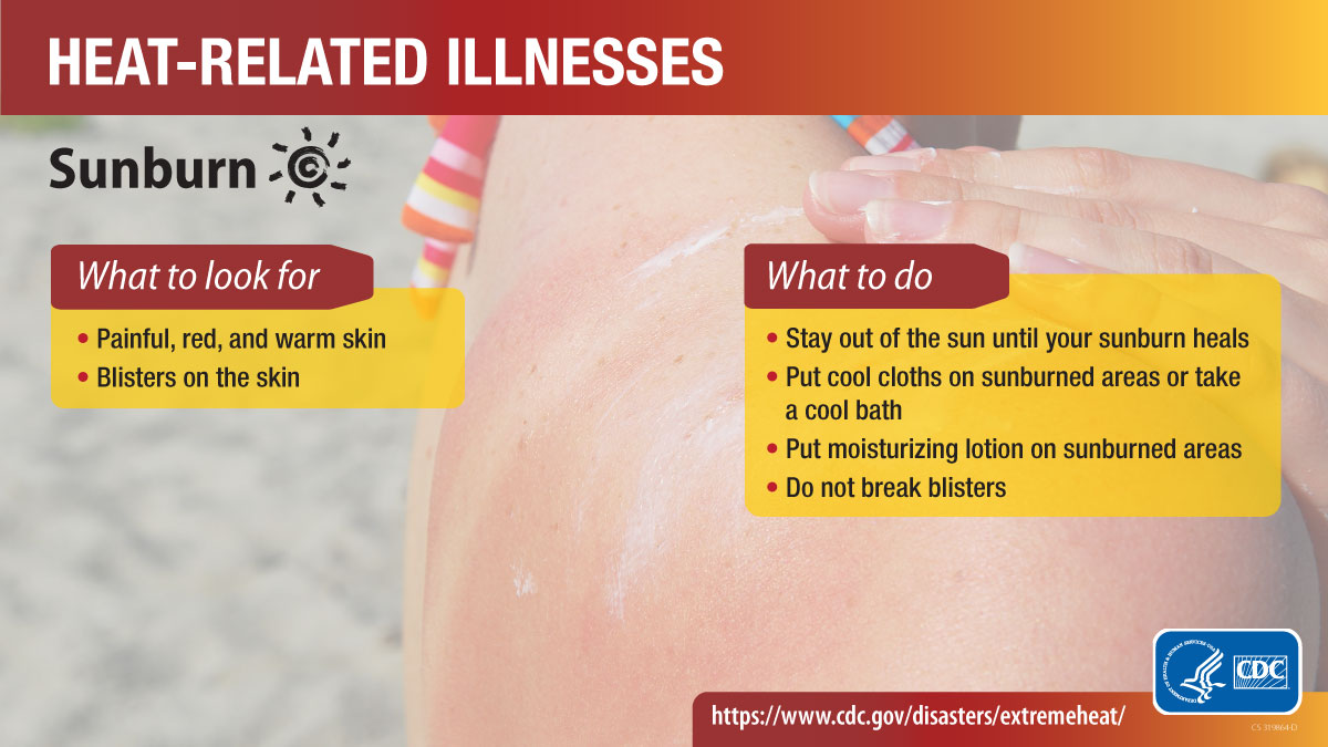 Heat-Related IIlnesses: Sunburn Heat-related illnesses social media graphic for heat sunburn. More info at www.cy118119.com/disasters/extremeheat/