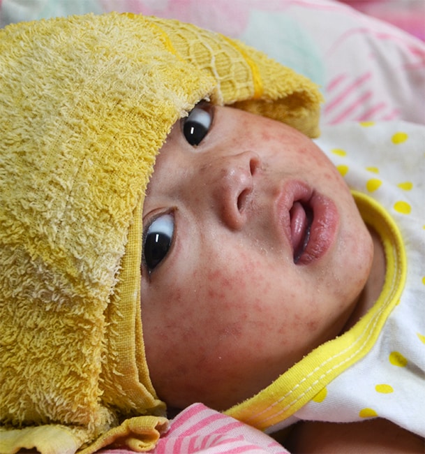 NCEZID Accomplishments 2019 - protecting travelers’ health A baby with measles