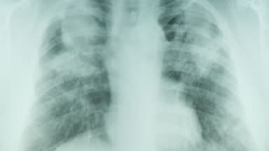 Lung x-ray showing pneumoconiosis in coal miner.